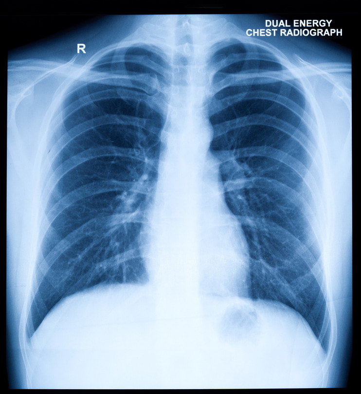 Types Of Chest X Rays At Donald Peterson Blog