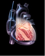 Transesophageal Echocardiography (TEE)