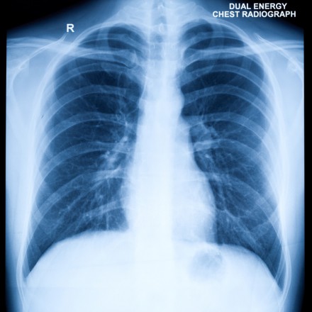 Chest X-Ray