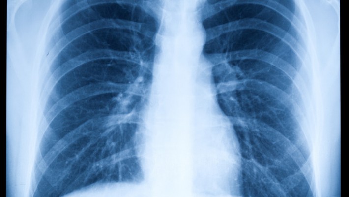 Chest X-Ray