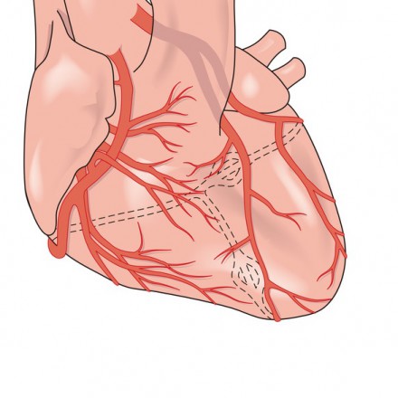 Coronary Artery Disease (CAD)