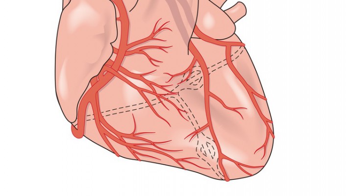 Coronary Artery Disease (CAD)