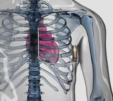 Defibrillator Implantation