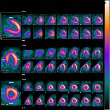 SPECT & PET Nuclear Stress Test