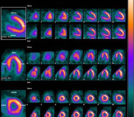 SPECT & PET Nuclear Stress Test