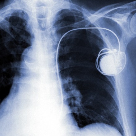 Pacemaker Monitoring