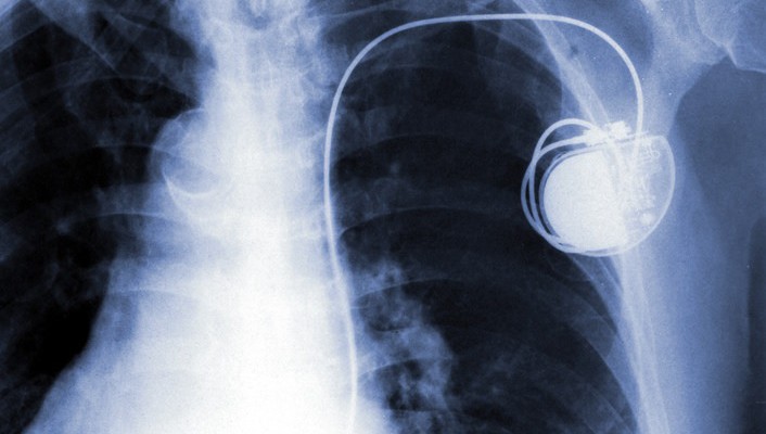 Pacemaker Monitoring