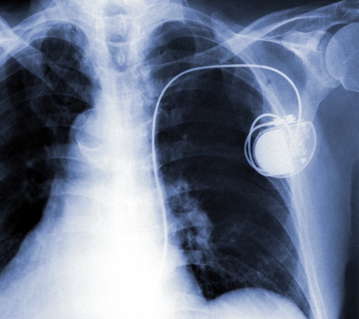 pacemaker implantation