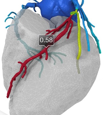 HeartFlow Analysis