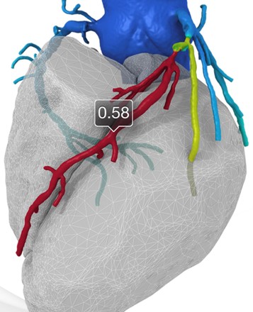 HeartFlow Analysis