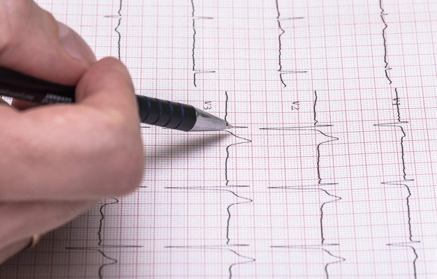 411: Atrial Fibrilation